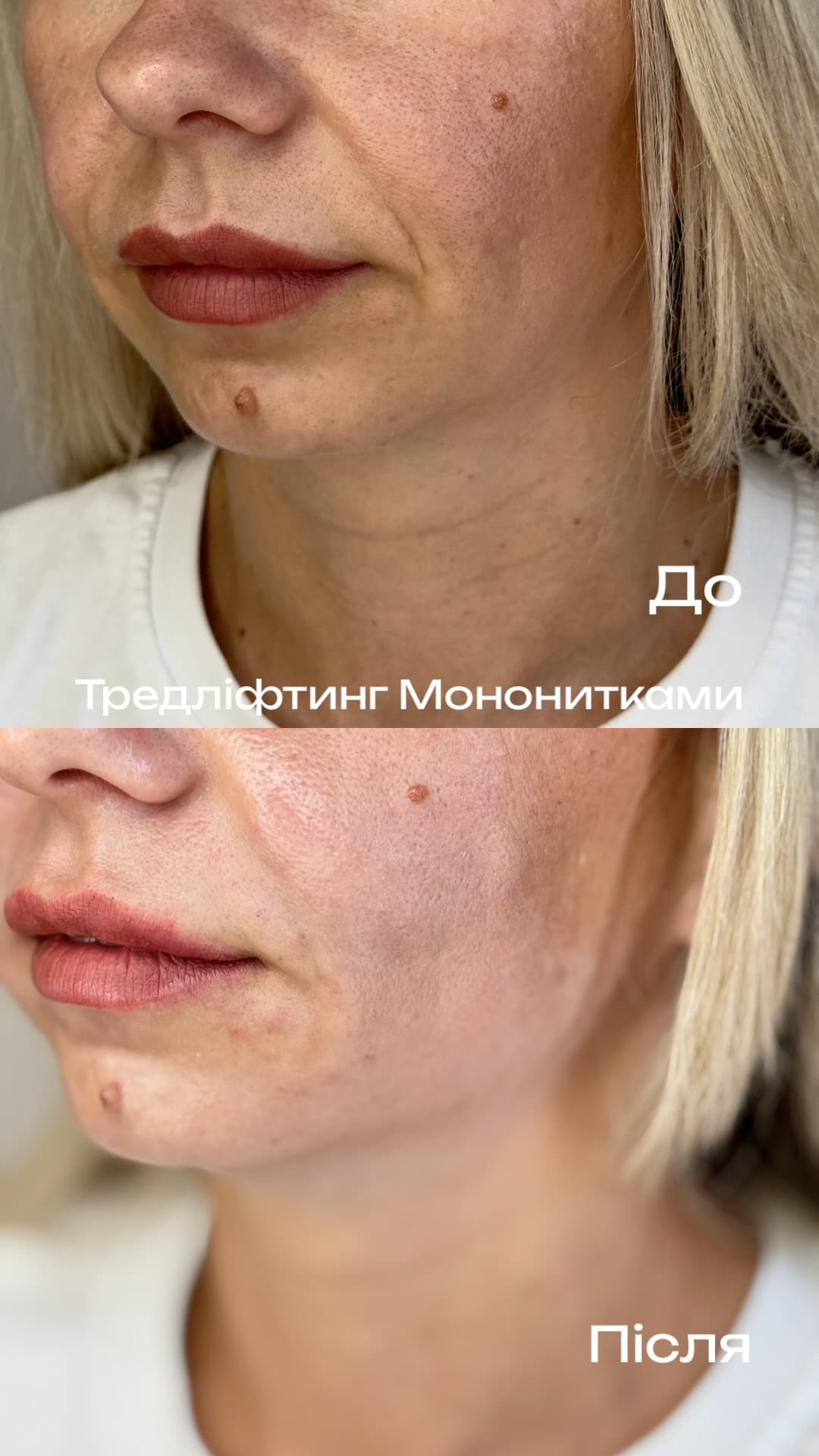Лікар косметолог Анастасія Касенко | Мерефа | Харків — робота 12